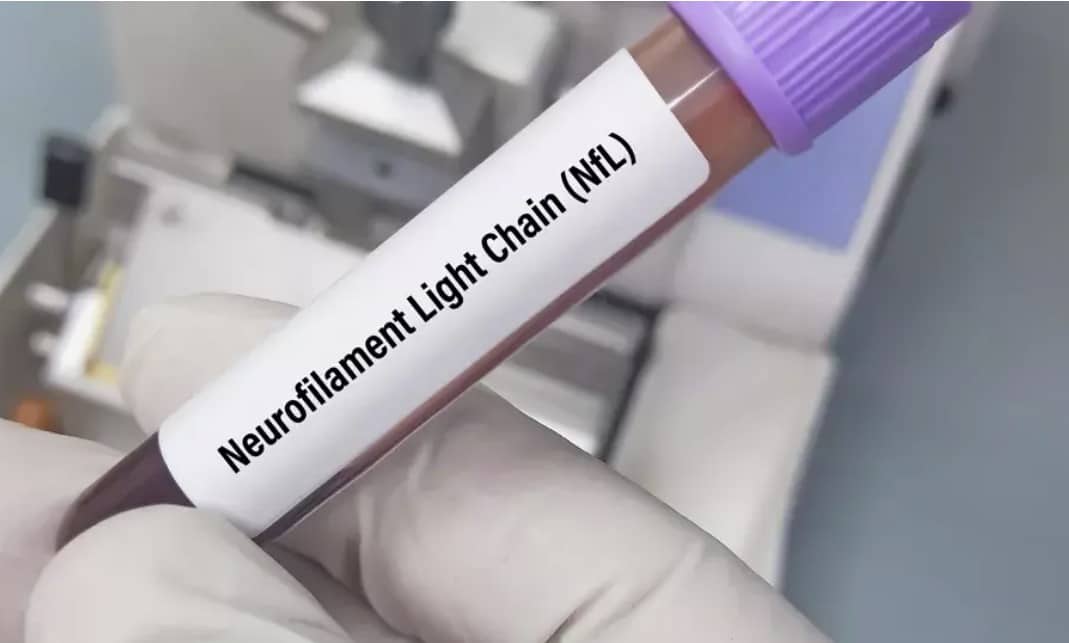 Featured image for “Could Serum Neurofilament Light (sNFL) Chain Level Help Guide MS Management?”