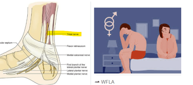 Featured image for “Tibial nerve stimulation may ease sexual dysfunction related to MS”